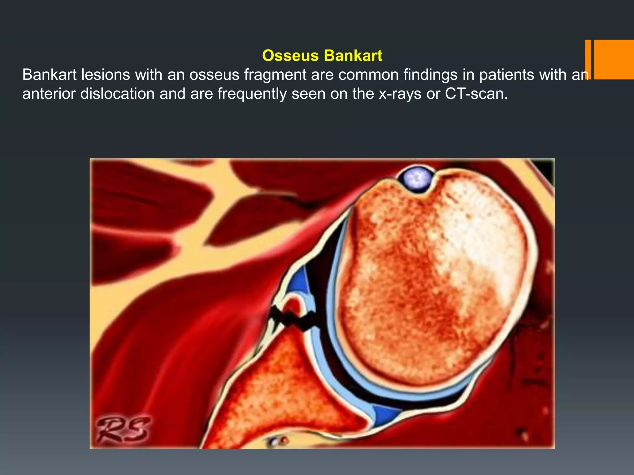 Osseus Bankart
Bankart lesions with an osseus fragment are common findings in patients with an
anterior dislocation and are frequently seen on the x-rays or CT-scan.
 