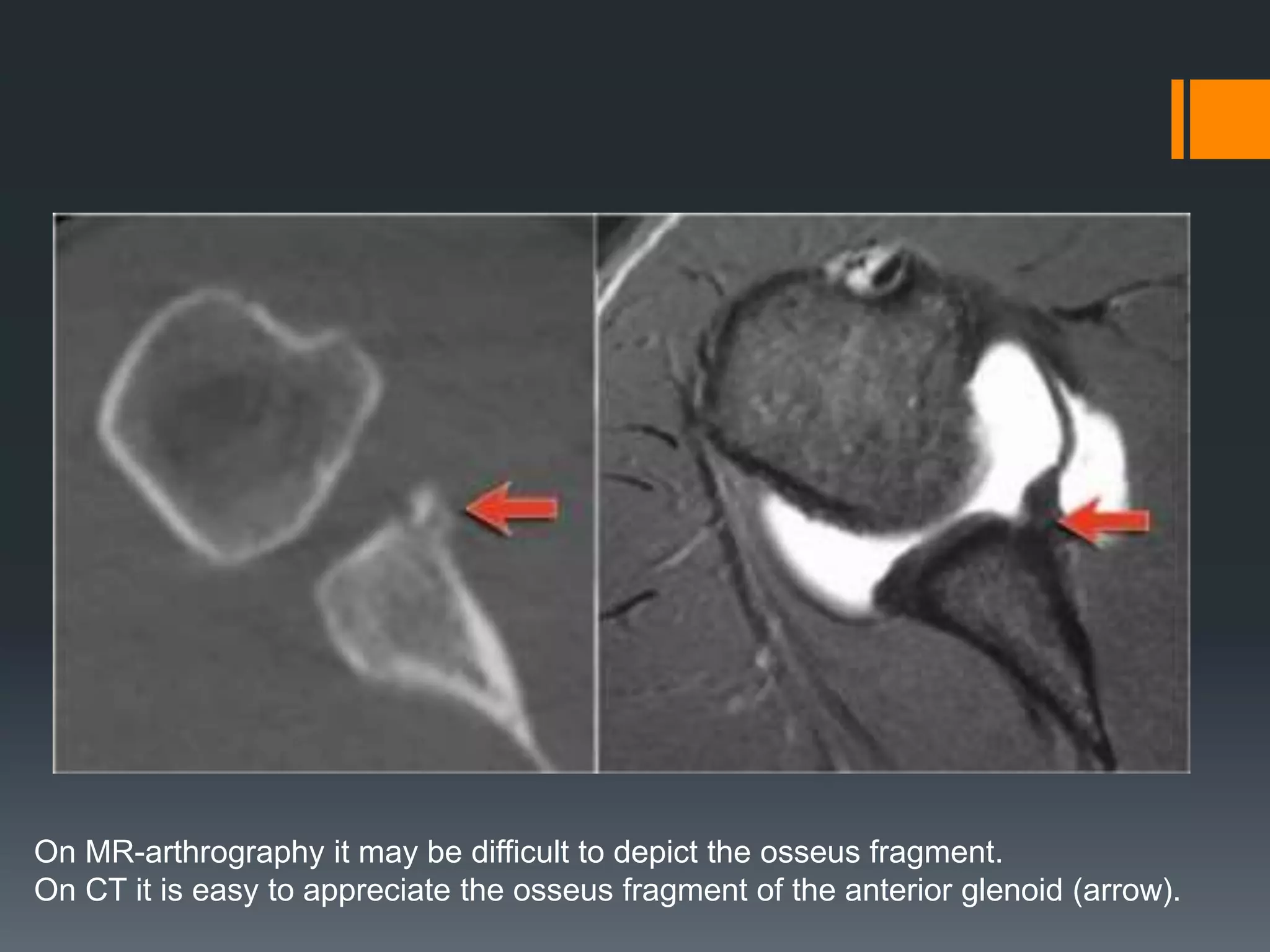 On MR-arthrography it may be difficult to depict the osseus fragment.
On CT it is easy to appreciate the osseus fragment of the anterior glenoid (arrow).
 