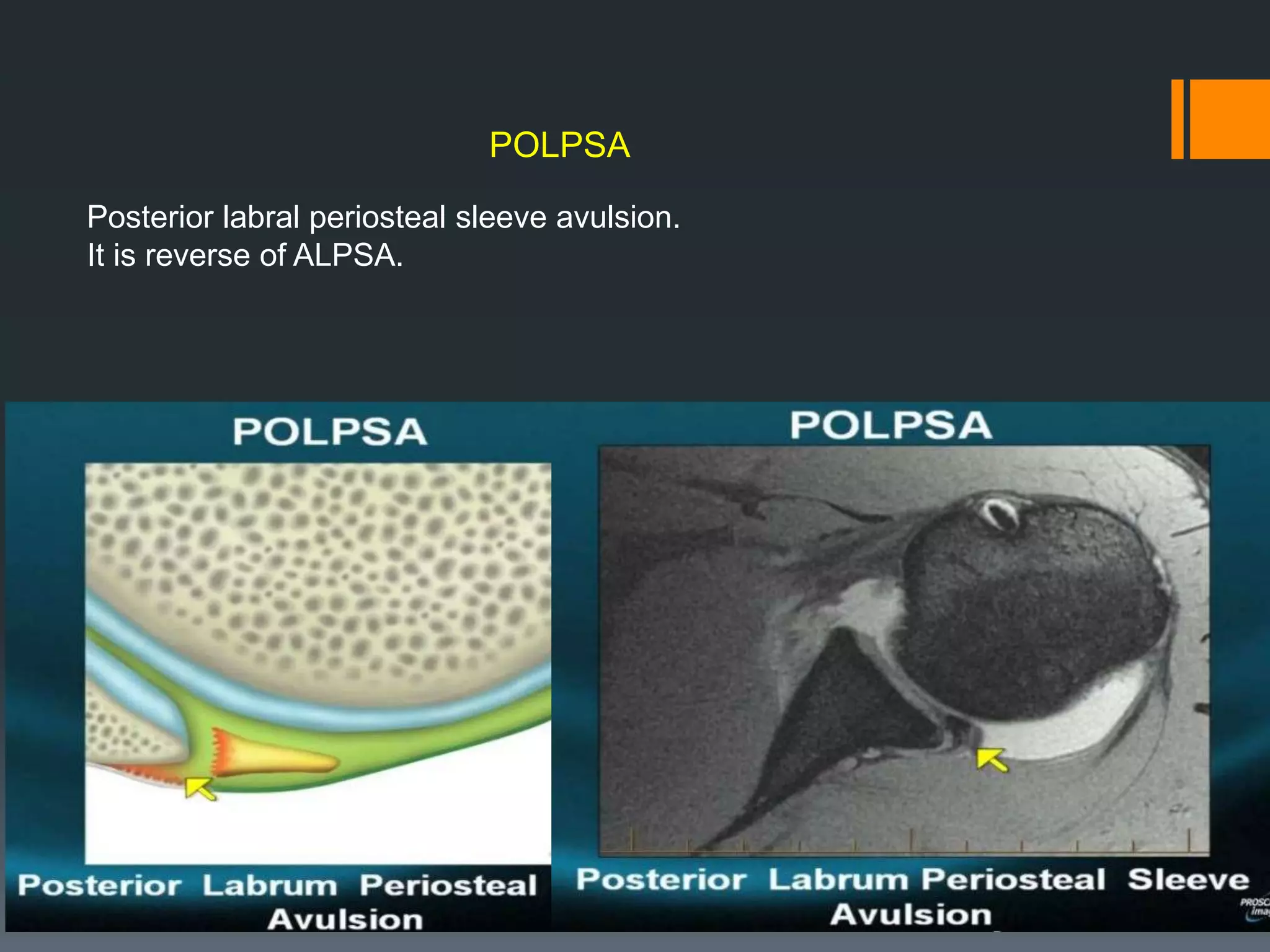 POLPSA
Posterior labral periosteal sleeve avulsion.
It is reverse of ALPSA.
 