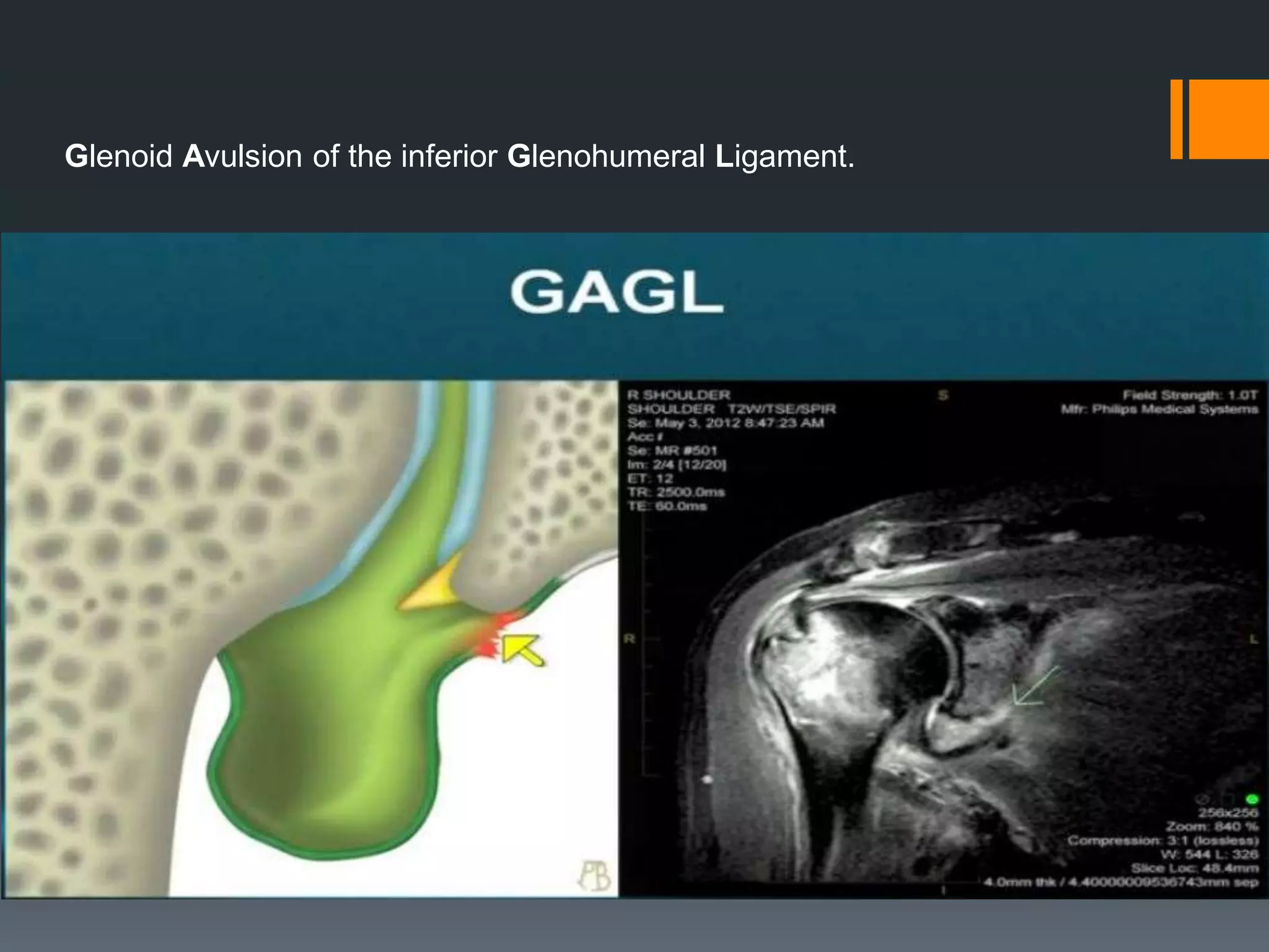 Glenoid Avulsion of the inferior Glenohumeral Ligament.
 