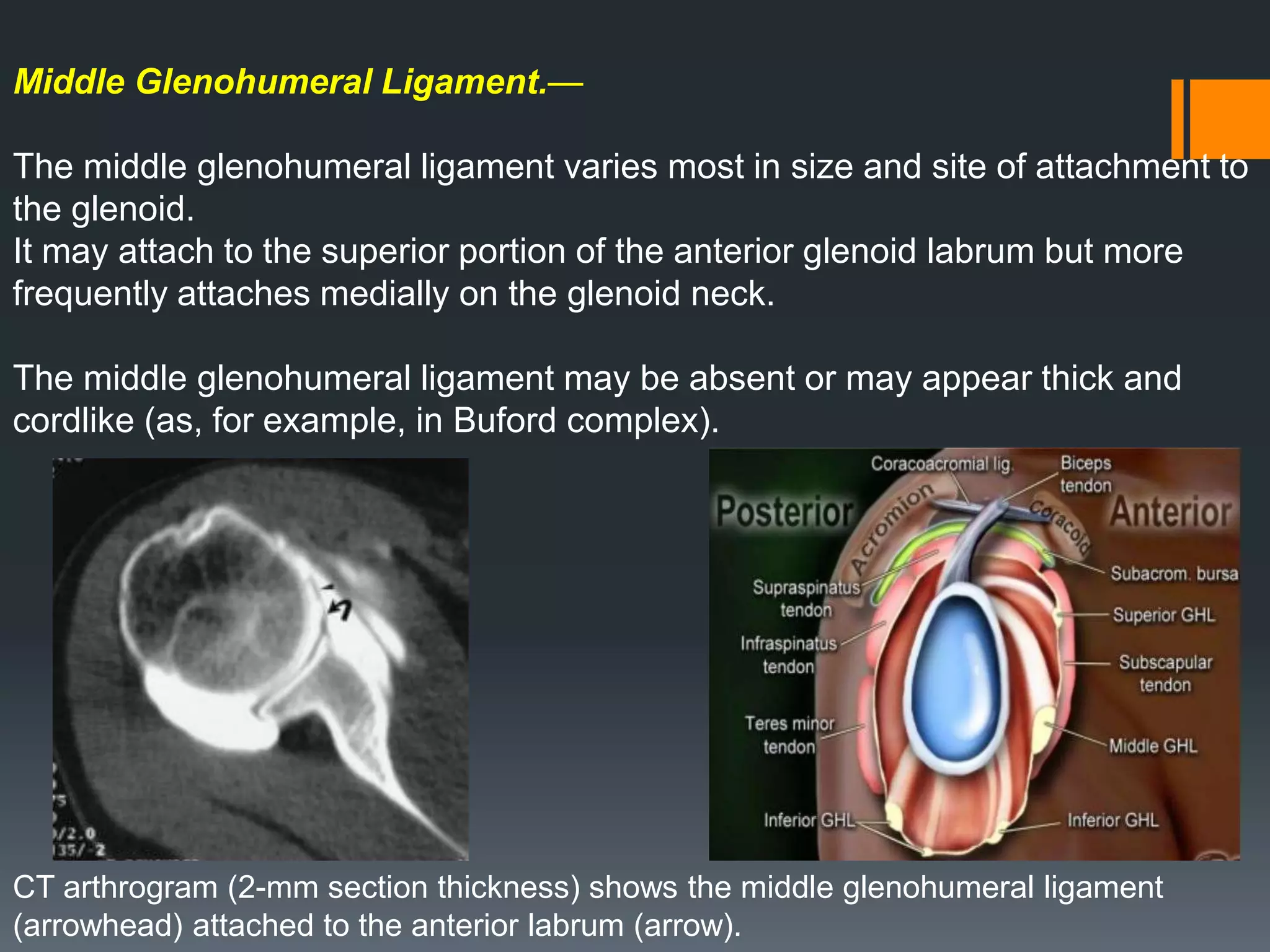 Middle Glenohumeral Ligament.—
The middle glenohumeral ligament varies most in size and site of attachment to
the glenoid.
It may attach to the superior portion of the anterior glenoid labrum but more
frequently attaches medially on the glenoid neck.
The middle glenohumeral ligament may be absent or may appear thick and
cordlike (as, for example, in Buford complex).
CT arthrogram (2-mm section thickness) shows the middle glenohumeral ligament
(arrowhead) attached to the anterior labrum (arrow).
 