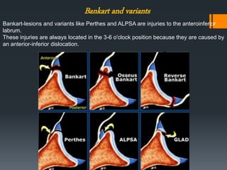 Shoulder labral tears MRI | PPTX