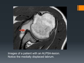 Shoulder labral tears MRI | PPTX