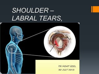 SHOULDER –
LABRAL TEARS,
VARAINTS.
 