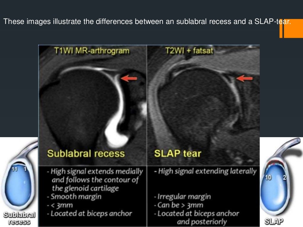 Shoulder labral tears MRI