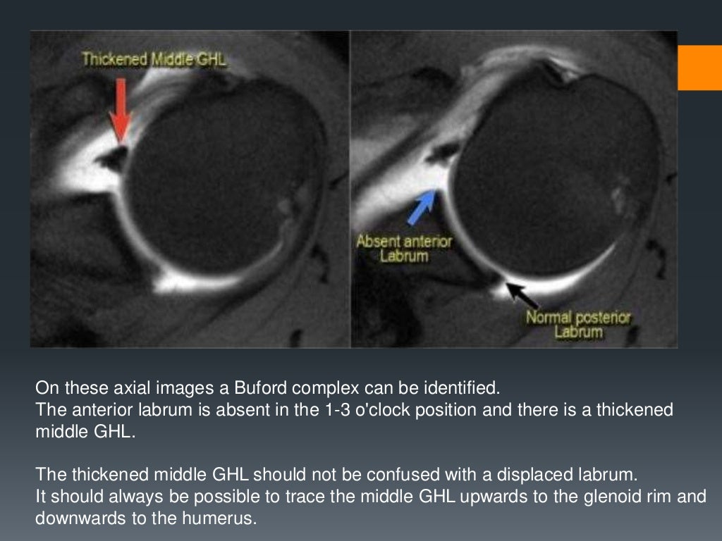 Anterior Labral Tear Shoulder