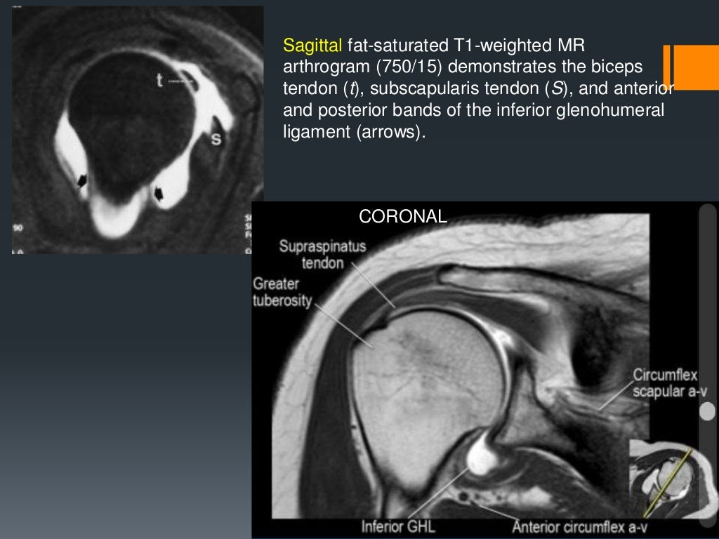 Shoulder labral tears MRI
