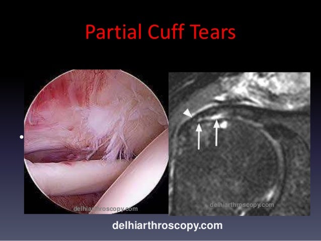 rotator cuff tear mri