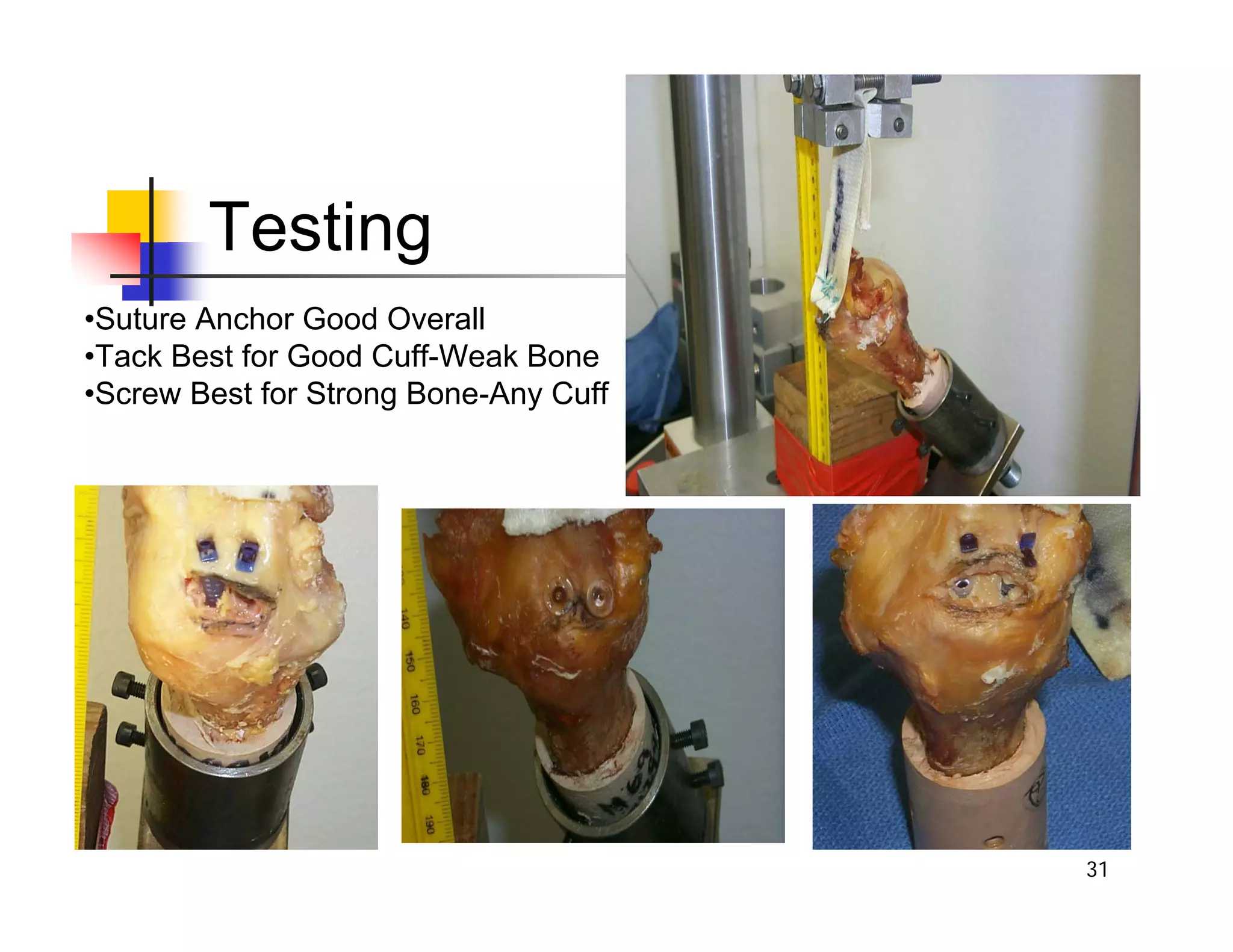 31
Testing
•Suture Anchor Good Overall
•Tack Best for Good Cuff-Weak Bone
•Screw Best for Strong Bone-Any Cuff
 