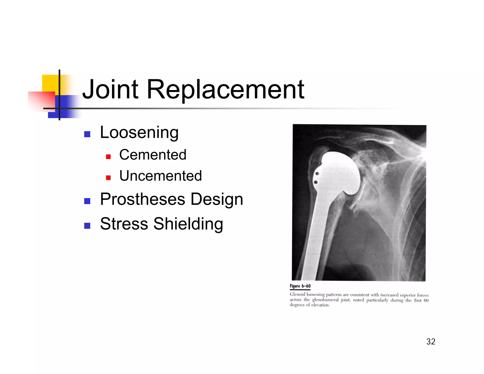 32
Joint Replacement
„ Loosening
„ Cemented
„ Uncemented
„ Prostheses Design
„ Stress Shielding
 