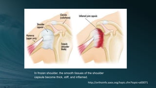 In frozen shoulder, the smooth tissues of the shoulder
capsule become thick, stiff, and inflamed.
http://orthoinfo.aaos.org/topic.cfm?topic=a00071
 
