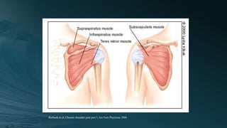 Burbank et al, Chronic shoulder pain part I, Am Fam Physician 2008
 