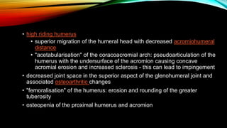 Shoulder pathologies | PPTX