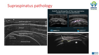 Pathological Shoulder Complex Shoulder Joint Common Pathologies & Interventions | Dr Shirish Amatya ...