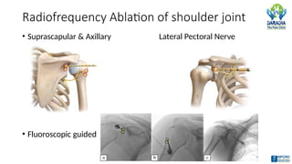 Suprascapular Rfa Procedure Shoulder Joint Common Pathologies & Interventions | Dr Shirish Amatya ...