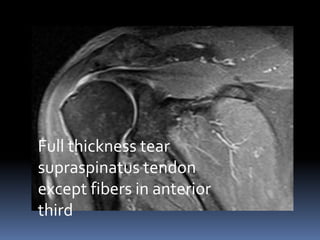 Full thickness tear 
supraspinatus tendon 
except fibers in anterior 
third 
 