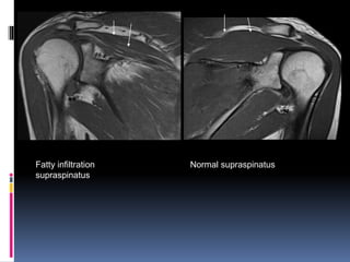 Fatty infiltration 
supraspinatus 
Normal supraspinatus 
 