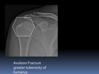 Avulsion Fracture 
greater tuberosity of 
humerus 
 