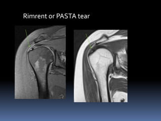 Rimrent or PASTA tear 
 