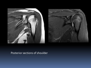 Posterior sections of shoulder 
 