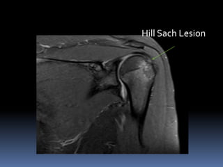 Hill Sach Lesion 
 
