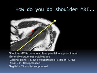 How do you do shoulder MRI.. 
Shoulder MRI is done in a plane parallel to supraspinatus. 
Generally sequences obtained are 
Coronal plane T1, T2, Fatsuppressed (STIR or PDFS) 
Axial - T1, fatsuppressed 
Sagittal - T2 and fat suppressed. 
 