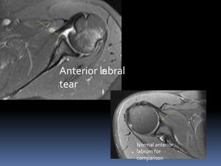 Anterior labral 
tear 
Normal anterior 
labrum for 
comparison 
 