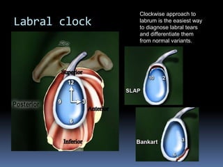Labral clock 
Clockwise approach to 
labrum is the easiest way 
to diagnose labral tears 
and differentiate them 
from normal variants. 
 