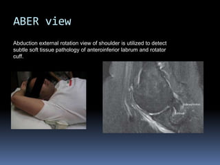ABER view 
Abduction external rotation view of shoulder is utilized to detect 
subtle soft tissue pathology of anteroinferior labrum and rotator 
cuff. 
 