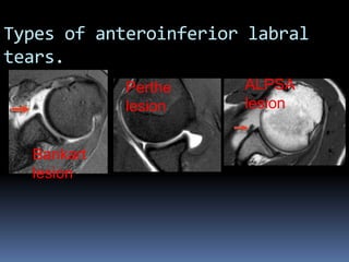 Types of anteroinferior labral 
tears. 
Bankart 
lesion 
Perthe 
lesion 
ALPSA 
lesion 
 