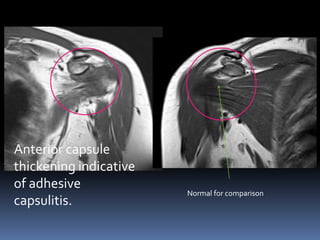 Anterior capsule 
thickening indicative 
of adhesive 
capsulitis. 
Normal for comparison 
 