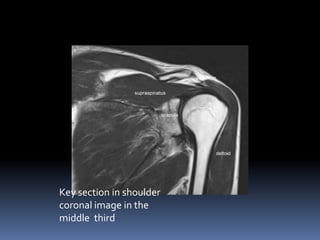 Key section in shoulder 
coronal image in the 
middle third 
 