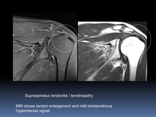 Supraspinatus tendonitis / tendinopathy 
MRI shows tendon enlargement and mild intratendinous 
hyperintense signal. 
 