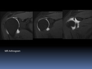 MR Arthrogram 
 