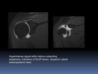 Hyperintense signal within labrum extending 
posteriorly. Indicative of SLAP lesion. (Superior Labral 
anteroposterior tear) 
 