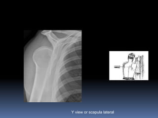Y view or scapula lateral 
 