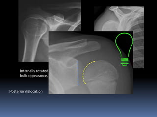 Internally rotated humerus giving light 
bulb appearance. Y view showing 
Posterior dislocation 
posterior 
dislocation. 
 