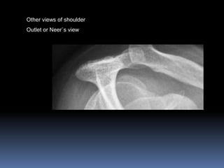 Other views of shoulder 
Outlet or Neer`s view 
 