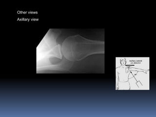 Other views 
Axillary view 
 