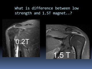 What is difference between low 
strength and 1.5T magnet..? 
0.2T 
1.5 T 
 
