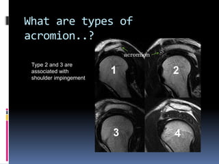 What are types of 
acromion..? 
Type 2 and 3 are 
associated with 
shoulder impingement 
 