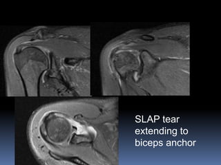 SLAP tear 
extending to 
biceps anchor 
 