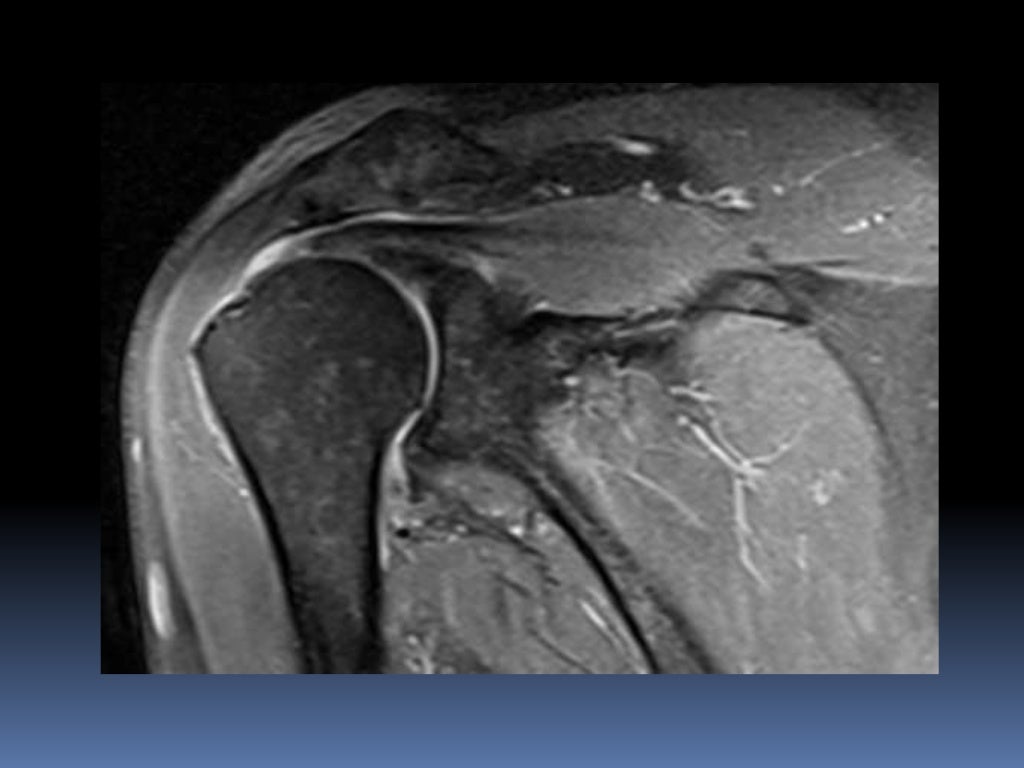 MRI OF SHOULDER INJURY