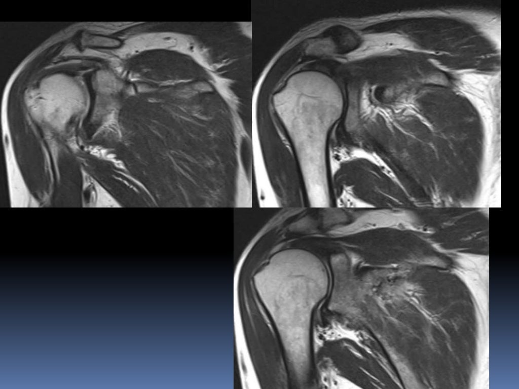 MRI OF SHOULDER INJURY