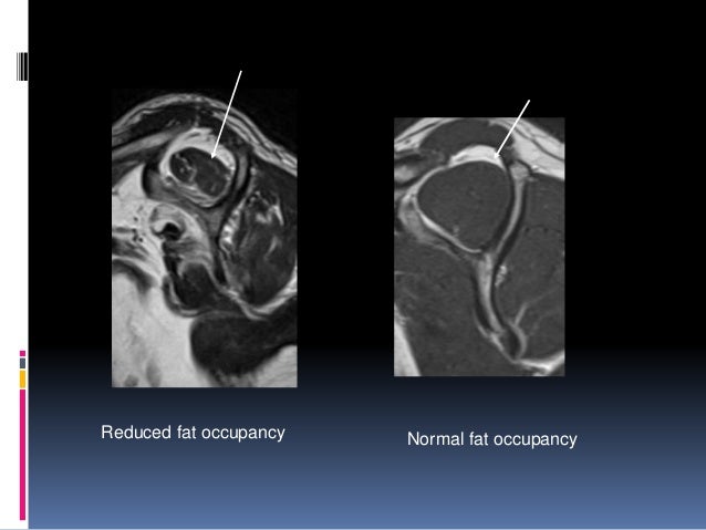 rotator cuff tear mri