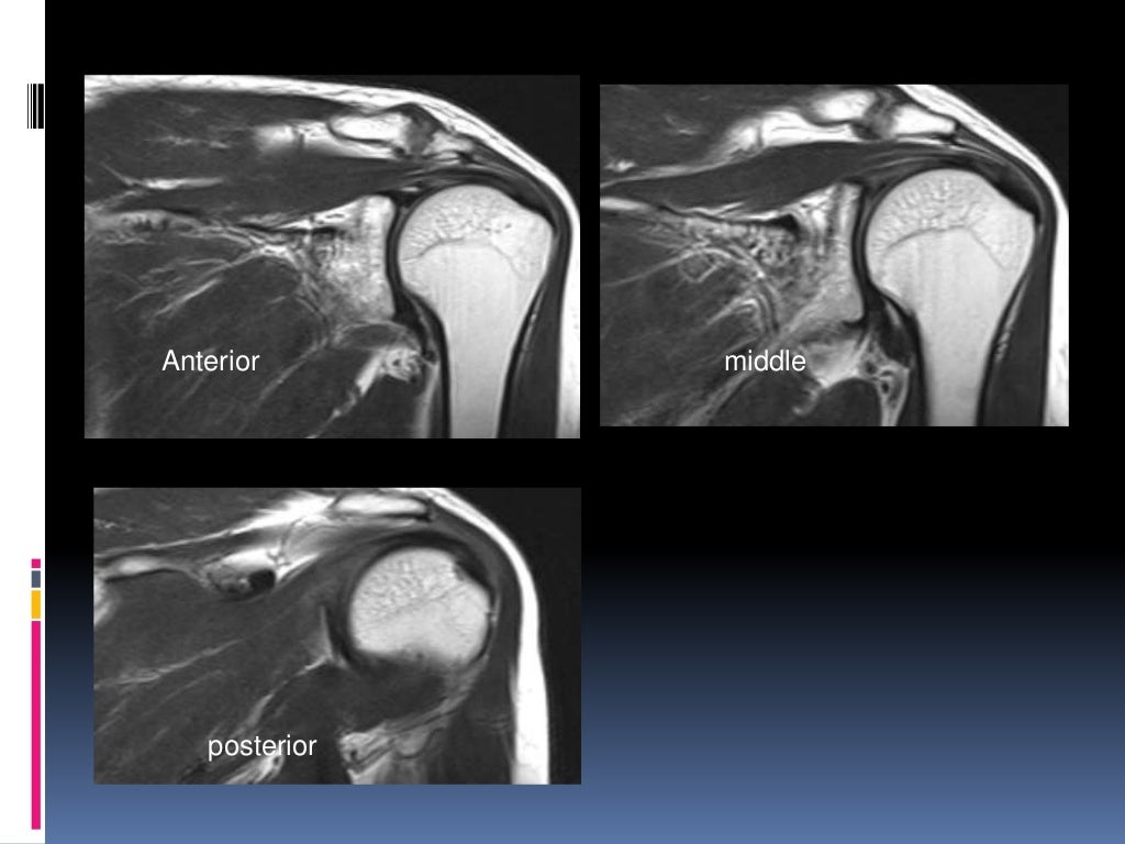 MRI OF SHOULDER INJURY