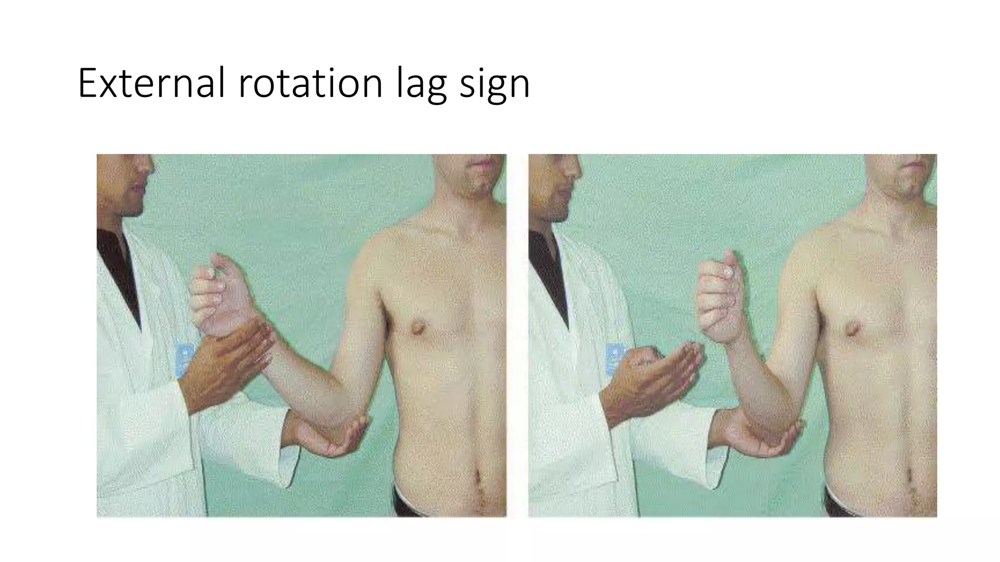 External rotation lag sign