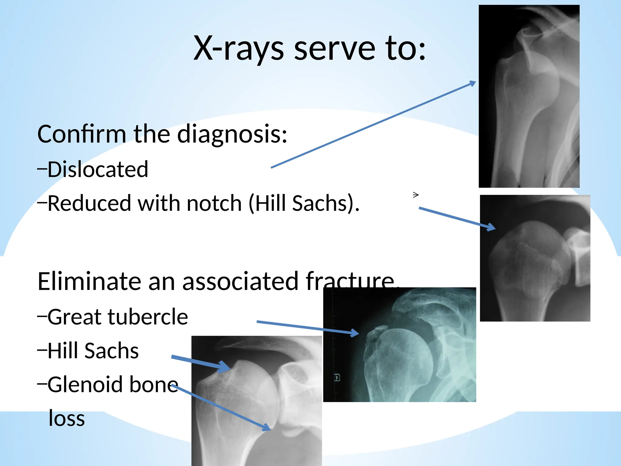 shoulder sports injuries ppt knee and shoulder | PPTX