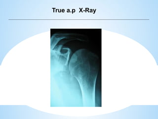 shoulder sports injuries ppt knee and shoulder | PPTX
