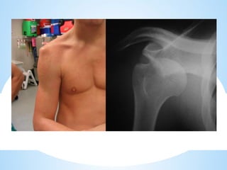 shoulder sports injuries ppt knee and shoulder | PPTX